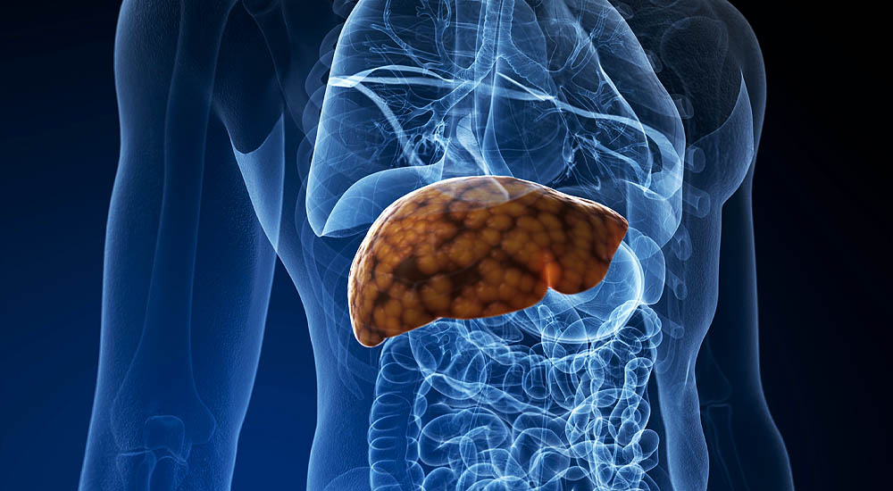 Fatty Liver Disease and Increased Risk of Viral Infection