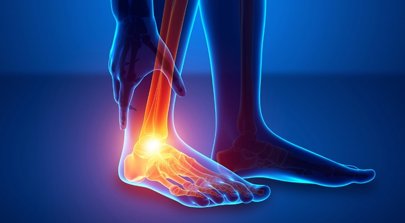 Is Your Pain Due to Plantar Fasciitis