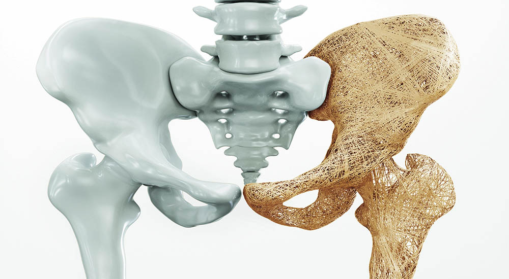 Preventing and Treating Osteoporosis