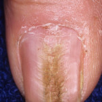 median-nail-dystrophy-optimized